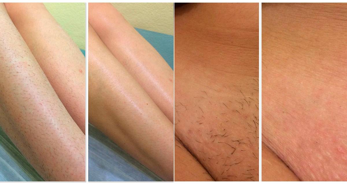 Можно ли брить ноги бритвой после эпилятора