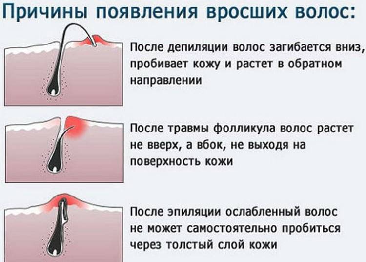 Как убрать вросшие волоски после эпиляции?