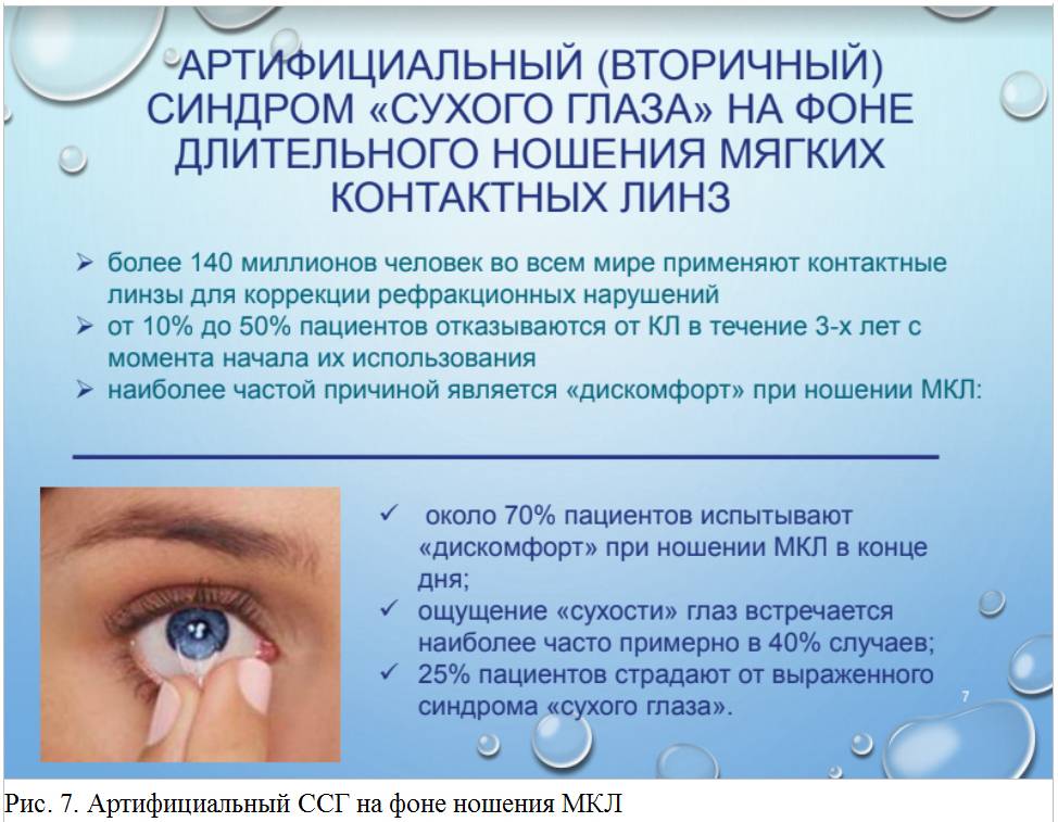 Линзы при сухости глаз. ССГ (синдром сухого глаза.